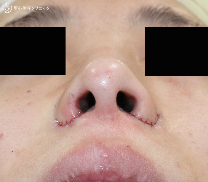 【20代女性・再手術の症例】小鼻縮小術+α法（1年後）札幌院 Before 