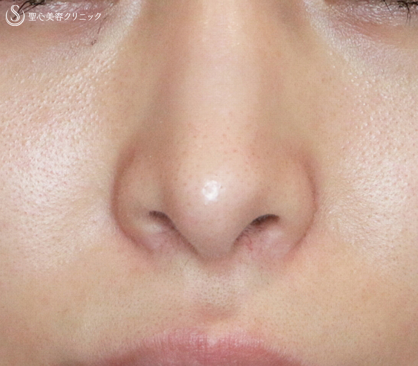 【20代女性・再手術の症例】小鼻縮小術+α法（1年後）札幌院 After 