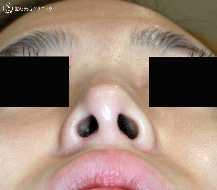 【20代女性・再手術の症例】小鼻縮小術+α法（1年後）札幌院 After 