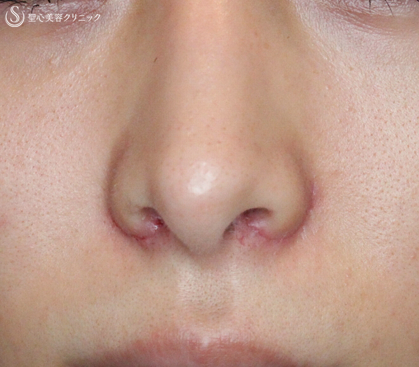 【20代女性・再手術の症例】小鼻縮小術+α法（1年後）札幌院 After 