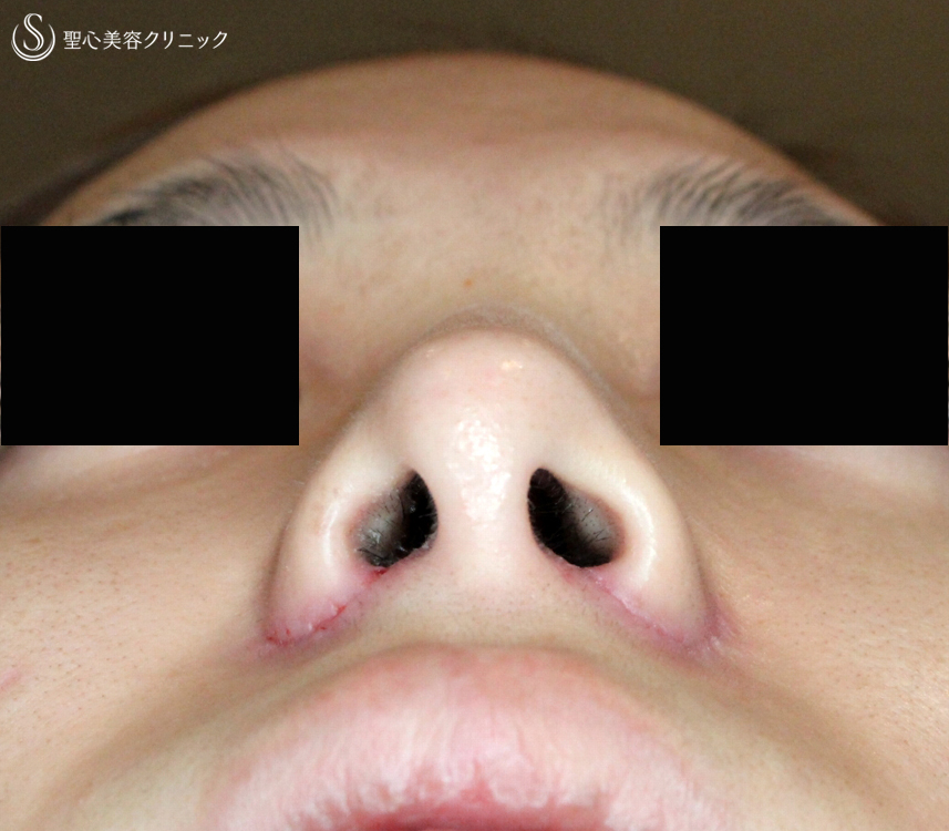 【20代女性・再手術の症例】小鼻縮小術+α法（1年後）札幌院 After 