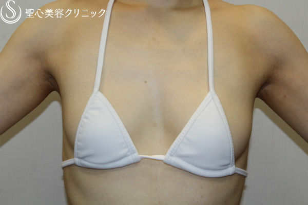 【40代女性・自然な質感に】脂肪幹細胞豊胸術（セリューション豊胸術)（3ヶ月後） Before 