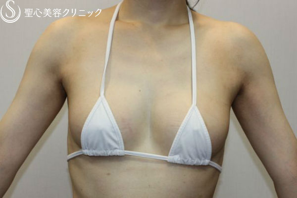 【40代女性・自然な質感に】脂肪幹細胞豊胸術（セリューション豊胸術)（3ヶ月後） After 
