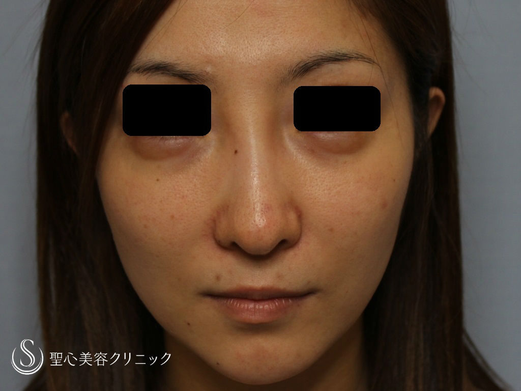 30代 女性 こめかみ 目の下 頬のくぼみ 脂肪注入 術後2ヶ月 症例写真 美容整形 美容外科なら聖心美容クリニック