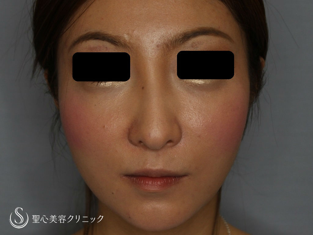 30代 女性 こめかみ 目の下 頬のくぼみ 脂肪注入 術後2ヶ月 症例写真 美容整形 美容外科なら聖心美容クリニック