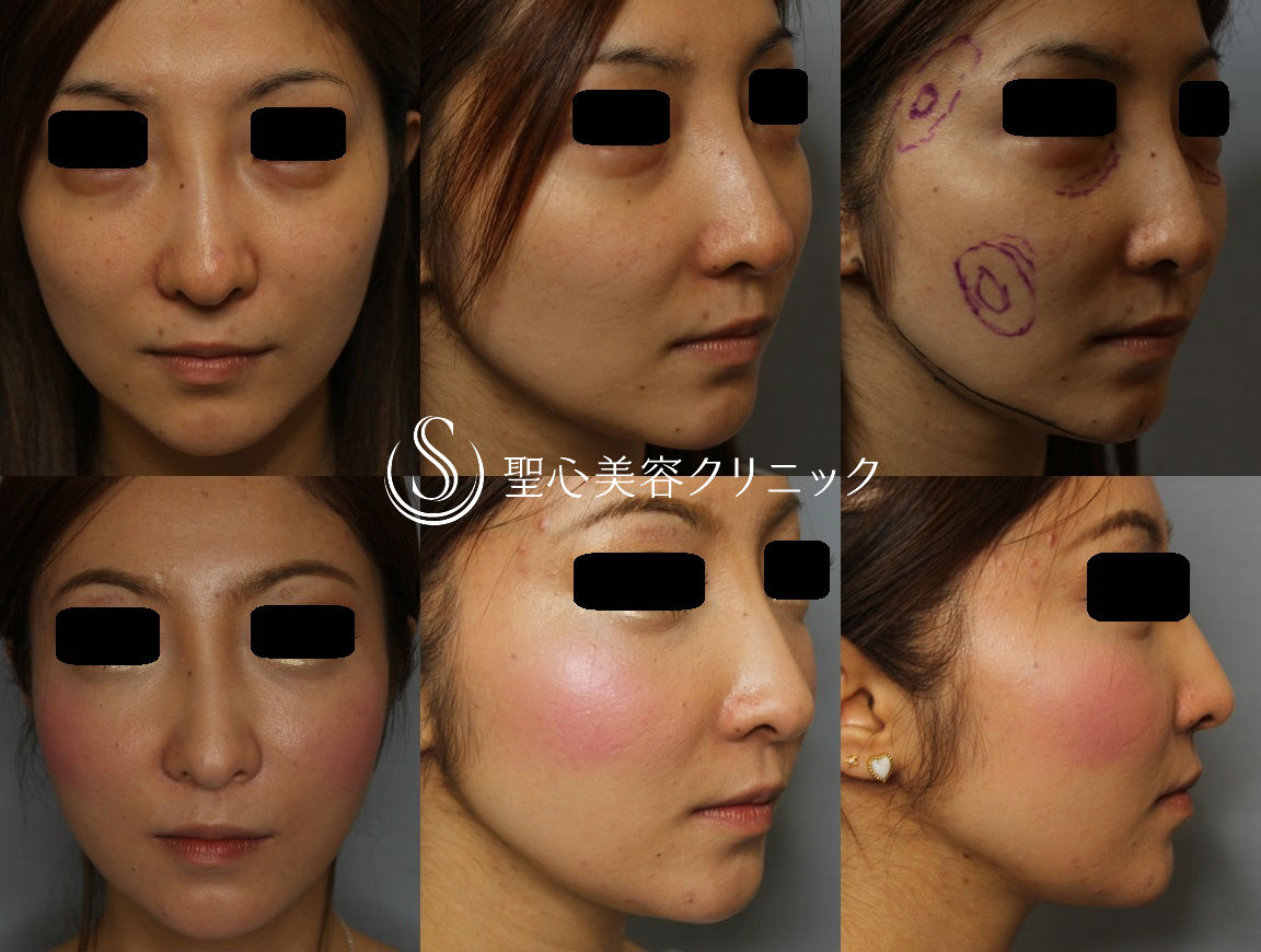 【30代・女性　こめかみ、目の下、頬のくぼみ】脂肪注入（術後2ヶ月） After 