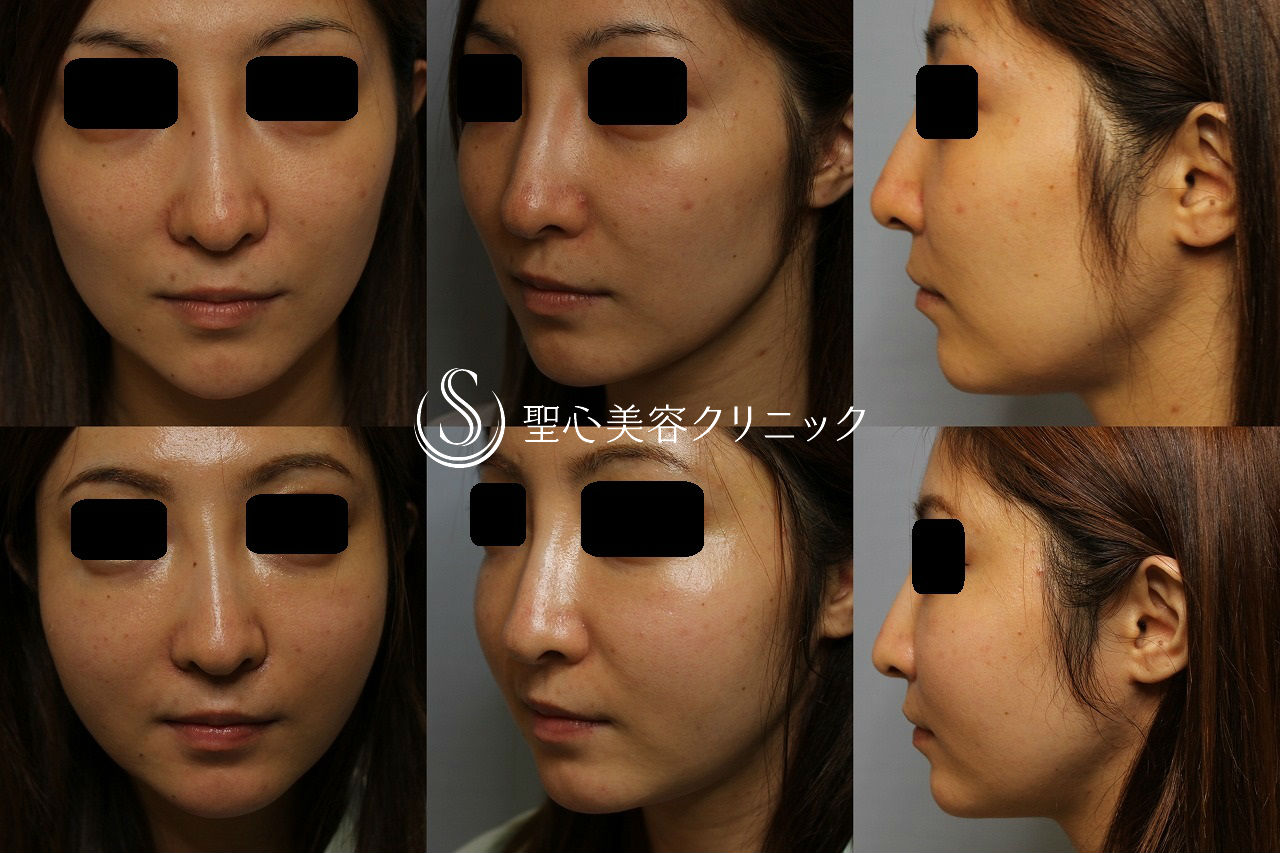 【30代・女性　こめかみ、目の下、頬のくぼみ】脂肪注入（術後2ヶ月） After 