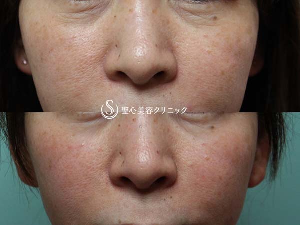 【女性・目の下の小ジワ、肌の乾燥】水光注射（処置後1ヶ月） After 