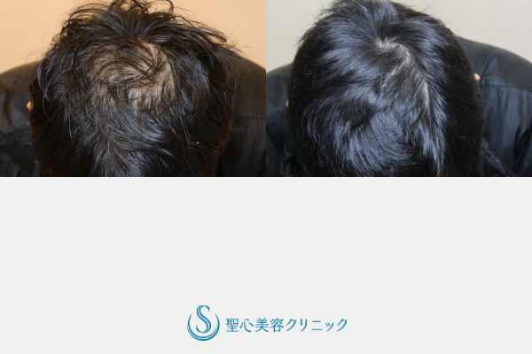 【40代男性・髪の毛の若返り】グロースファクター再生療法＋複合治療 After 