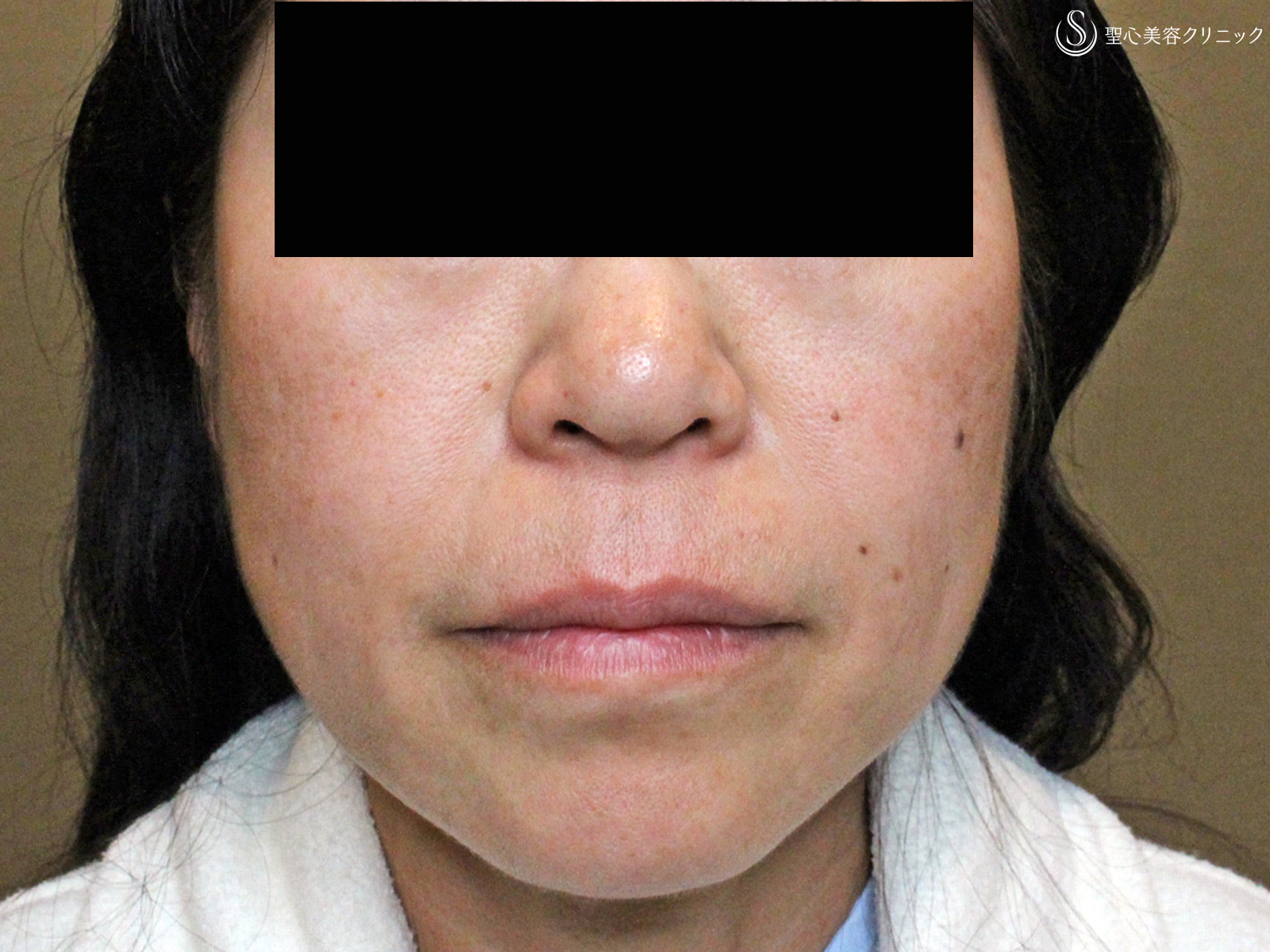 50代女性 フェイスリフト プレミアミニリフト リガメント処理 9ヶ月後 症例写真 美容整形 美容外科なら聖心美容クリニック 50代女性 フェイスリフト プレミアミニリフト リガメント処理 9ヶ月後 症例写真 美容整形 美容外科なら聖心美容クリニック