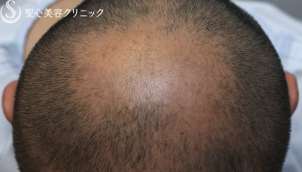 【男性・毛髪再生】脂肪由来幹細胞移植による毛髪再生 Before 