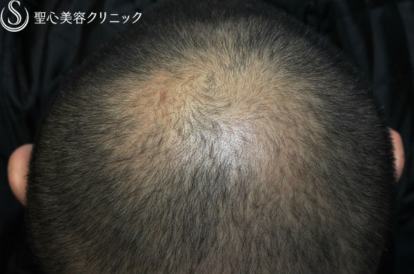 【男性・毛髪再生】脂肪由来幹細胞移植による毛髪再生 After 