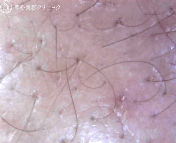 【男性・毛髪再生】脂肪由来幹細胞移植による毛髪再生 Before 