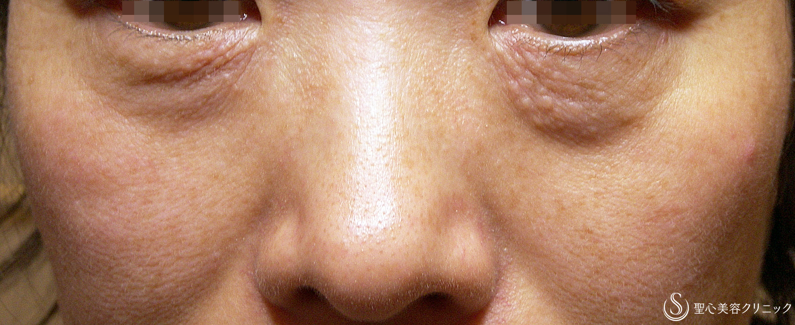 【50代女性・目の下のクマ長期経過】プレミアムPRP療法（7年後） Before 