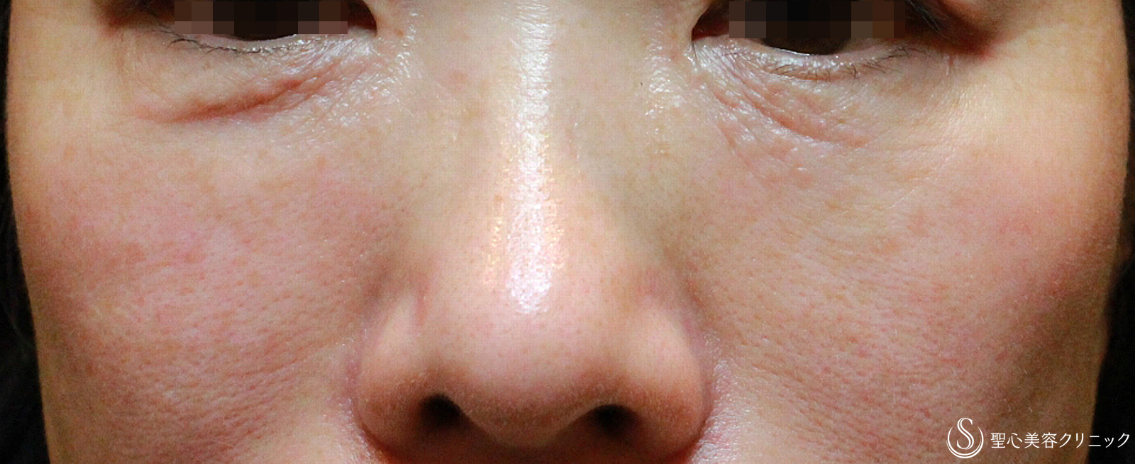 【50代女性・目の下のクマ長期経過】プレミアムPRP療法（7年後） After 