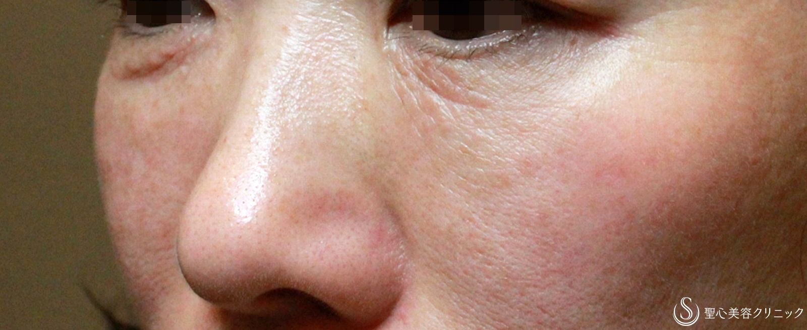 【50代女性・目の下のクマ長期経過】プレミアムPRP療法（7年後） After 