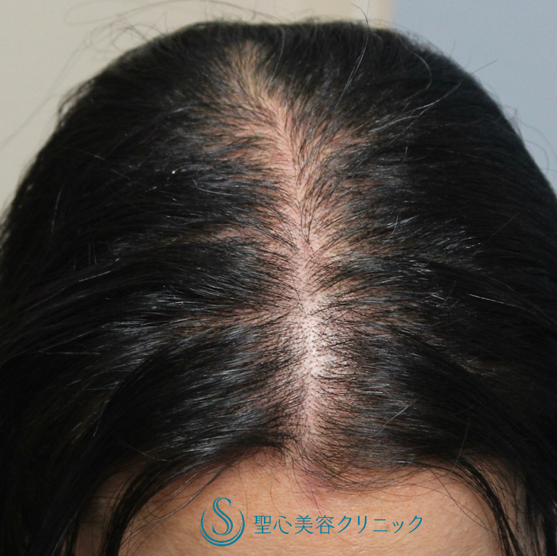 【30代女性・グロースファクター再生療法（エレクトロポレーション法）】毛髪複合治療(16回コース後) Before 