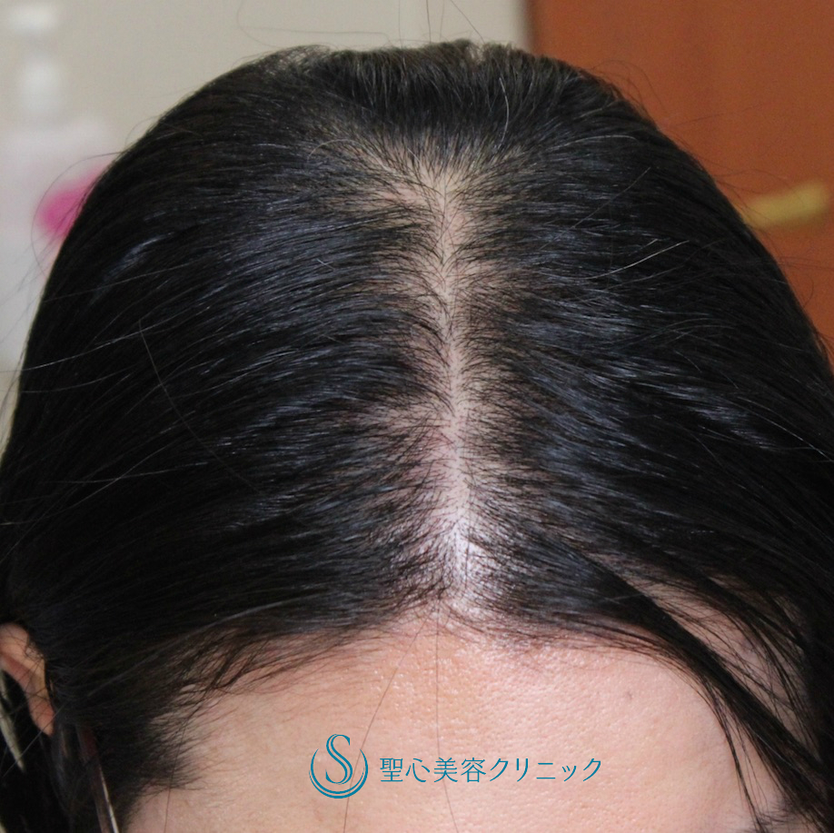 【30代女性・グロースファクター再生療法（エレクトロポレーション法）】毛髪複合治療(16回コース後) After 
