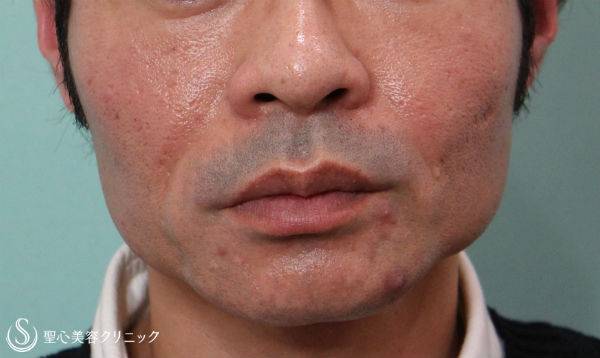 【30代男性・フェイスラインをスッキリと】ボトックス注入、ヒゲ脱毛、プレミアムPRP After 