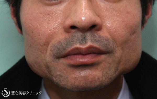 【30代男性・フェイスラインをスッキリと】ボトックス注入、ヒゲ脱毛、プレミアムPRP Before 