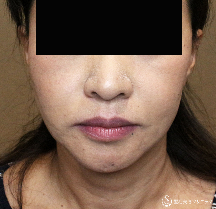 50代女性 頬のタルミ プレミアミニリフト リガメント処理 ベイザー脂肪吸引 2年4ヶ月後 症例写真 美容整形 美容外科なら聖心美容クリニック 50代女性 頬のタルミ プレミアミニリフト リガメント処理 ベイザー脂肪吸引 2年4ヶ月後 症例写真 美容整形 美容外科なら聖心美容クリニック