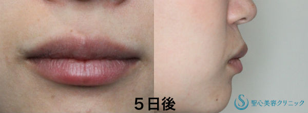 【20代女性・カサカサくちびる】口唇へのヒアルロン酸注入 After 