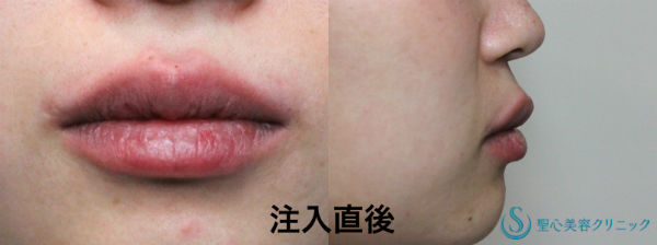 【20代女性・カサカサくちびる】口唇へのヒアルロン酸注入 After 