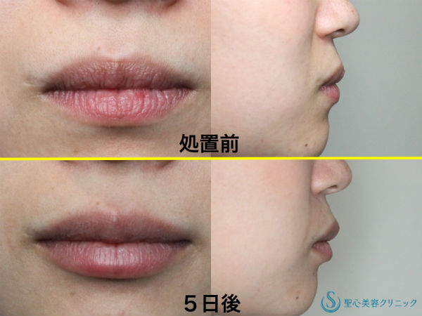 【20代女性・カサカサくちびる】口唇へのヒアルロン酸注入 After 