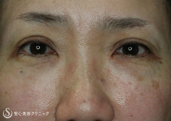 【50代女性・目元の印象変化】眼瞼下垂（がんけんかすい）埋没法 After 