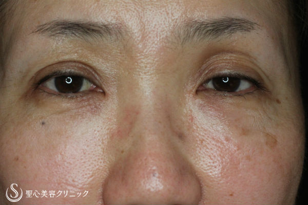 【50代女性・目元の印象変化】眼瞼下垂（がんけんかすい）埋没法 Before 