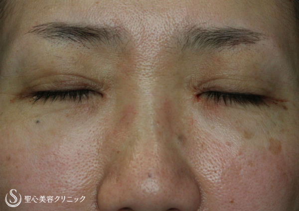 【50代女性・目元の印象変化】眼瞼下垂（がんけんかすい）埋没法 After 