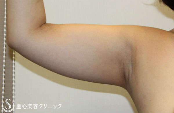 【30代女性・二の腕を細く】ベイザー脂肪吸引 Before 