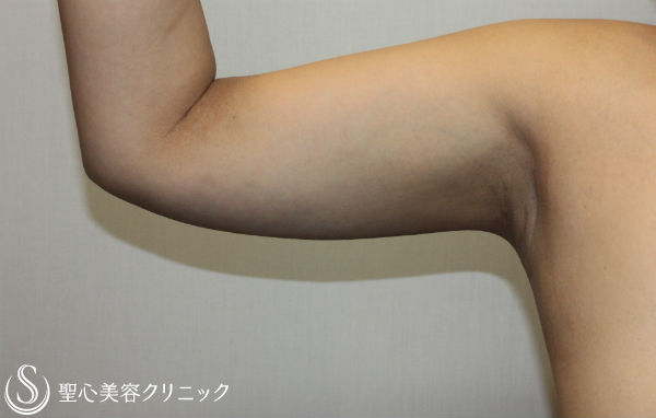 【30代女性・二の腕を細く】ベイザー脂肪吸引 After 