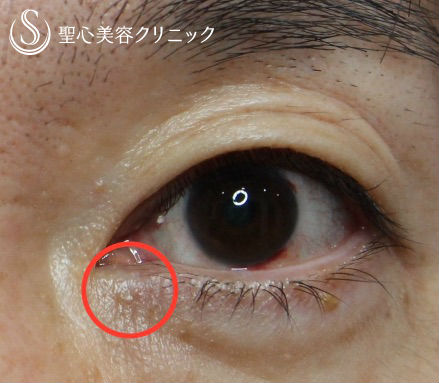 【目の下のイボ除去】 ホクロ・イボ After 