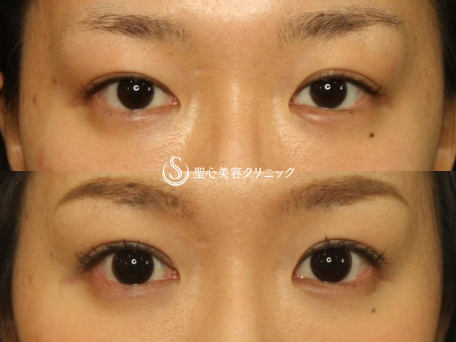 ２０代女性 二重全切開後の左右差修正 自院修正 症例写真 美容整形 美容外科なら聖心美容クリニック