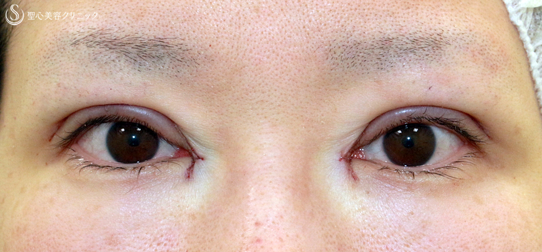 【30代女性・華やかな二重・全切開+αの第一例目】二重全切開+α法&目頭切開(7年後) 症例写真 美容整形、美容外科なら聖心美容クリニック 【30代女性・華やかな二重・全切開+αの第一例目】二重全切開+α法&目頭切開(7年後) 症例写真 美容整形、美容外科なら聖心美容クリニック