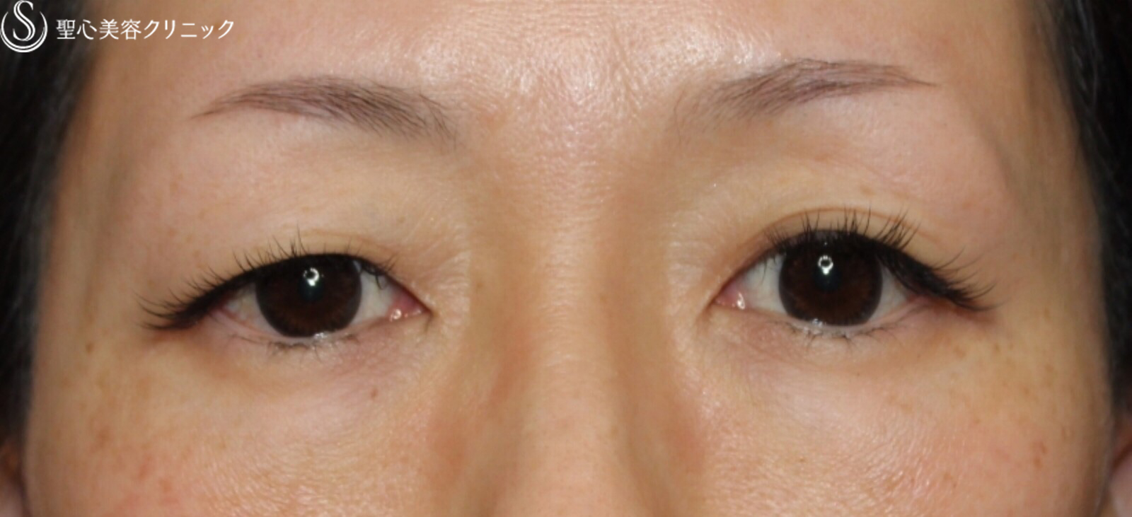 【40代女性・二重まぶたに】二重埋没法（マイクロメソッド＋α）（1ヶ月後） Before 