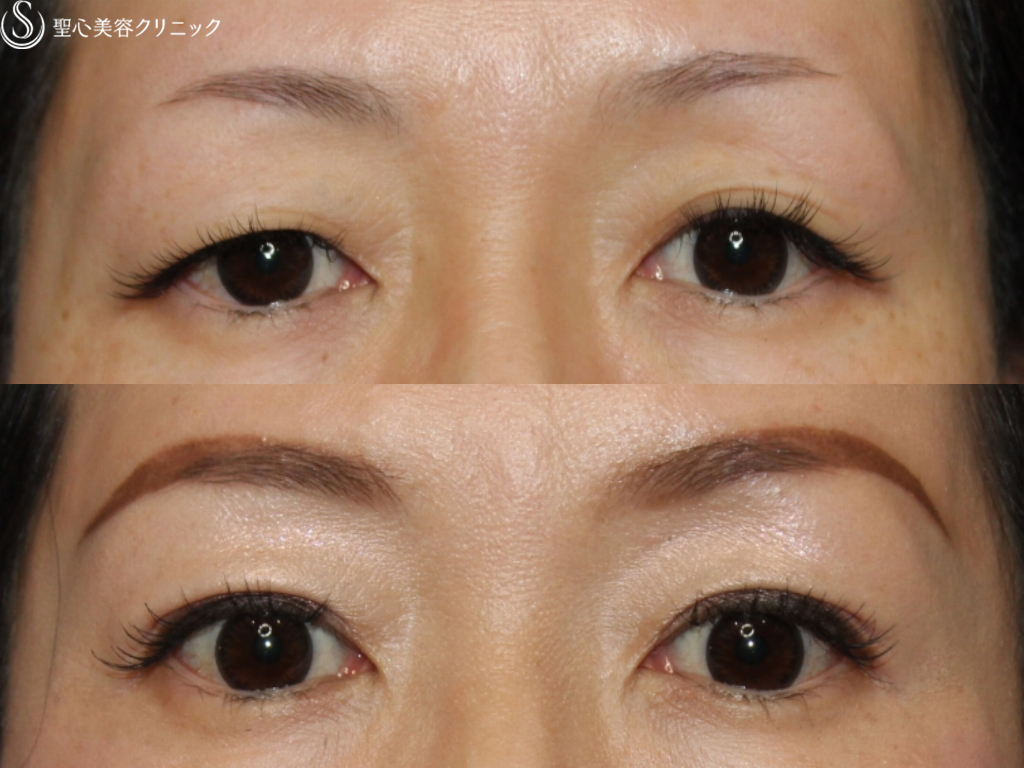 【40代女性・二重まぶたに】二重埋没法（マイクロメソッド＋α）（1ヶ月後） After 