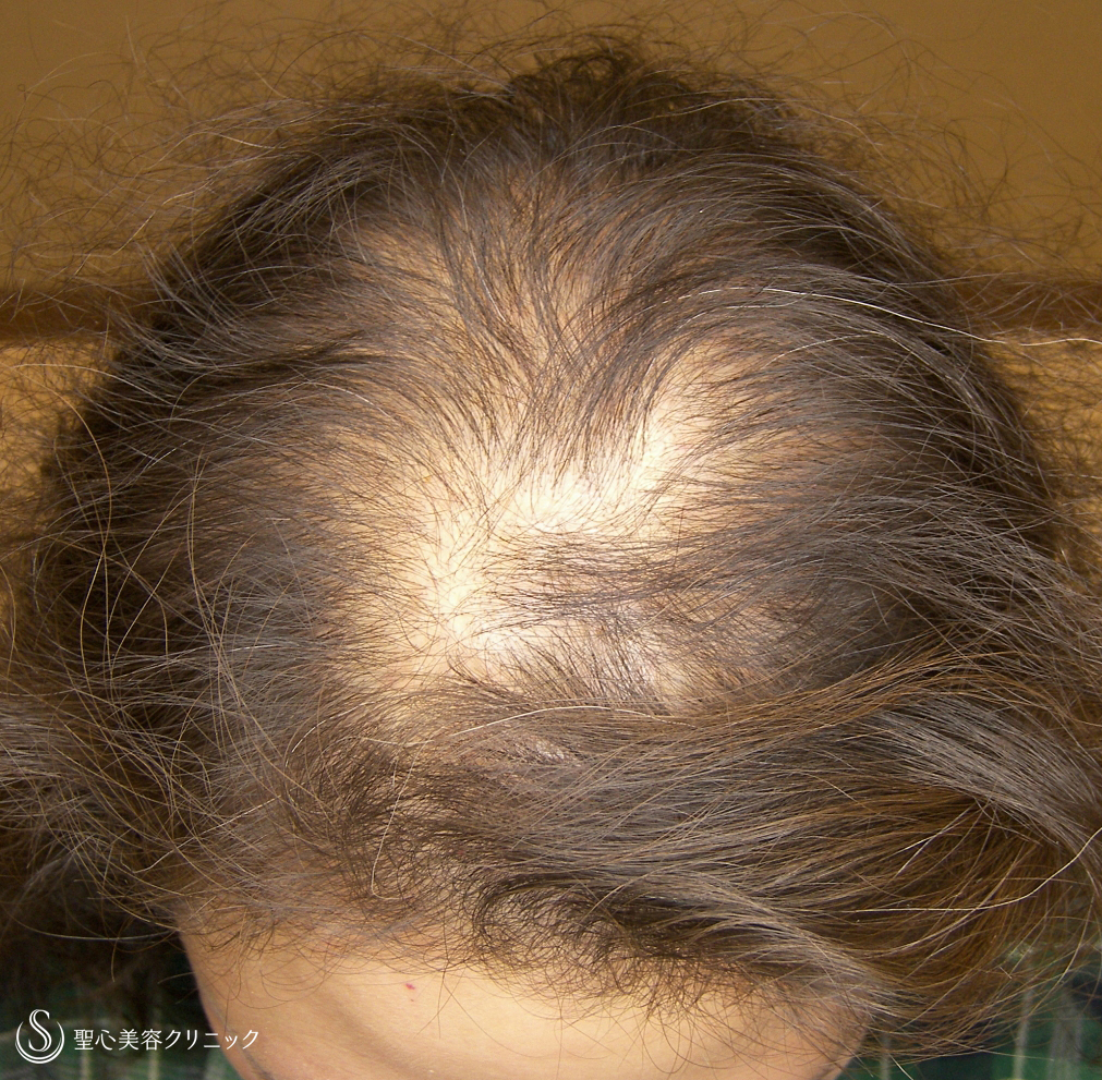【40代女性・びまん性脱毛】グロースファクター毛髪再生療法（8回後） 症例写真 美容整形、美容外科なら聖心美容クリニック