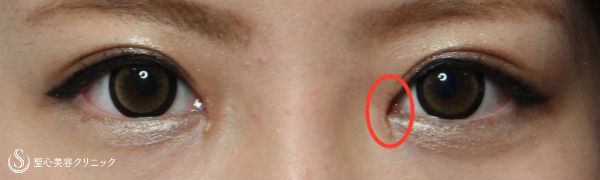 【女性・目の横幅を広く】目頭切開・Z法（経過） After 