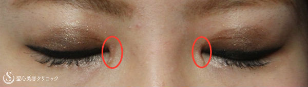 【女性・目の横幅を広く】目頭切開・Z法（経過） After 