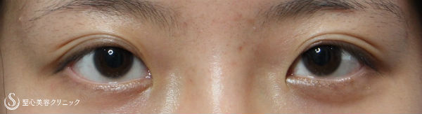 【女性・目の横幅を広く】目頭切開・Z法（経過） Before 