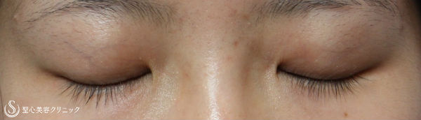 【女性・目の横幅を広く】目頭切開・Z法（経過） Before 