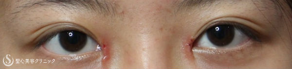 【女性・目の横幅を広く】目頭切開・Z法（経過） After 