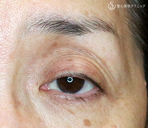【50代女性・埋没法で眼瞼下垂手術+同時に二重】切らない眼瞼下垂+α法（術直後）札幌院 Before 