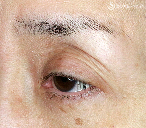 【50代女性・埋没法で眼瞼下垂手術+同時に二重】切らない眼瞼下垂+α法（術直後）札幌院 Before 