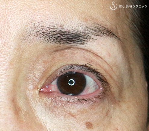 【50代女性・埋没法で眼瞼下垂手術+同時に二重】切らない眼瞼下垂+α法（術直後）札幌院 After 