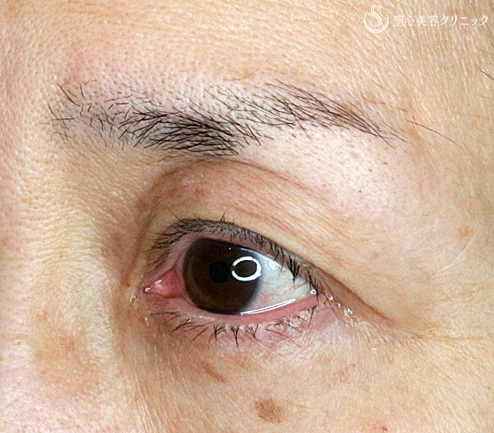 【50代女性・埋没法で眼瞼下垂手術+同時に二重】切らない眼瞼下垂+α法（術直後）札幌院 After 