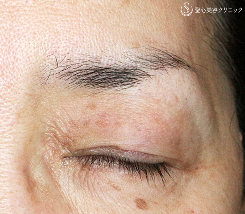 【50代女性・埋没法で眼瞼下垂手術+同時に二重】切らない眼瞼下垂+α法（術直後）札幌院 After 