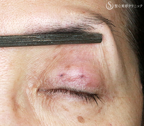 【50代女性・埋没法で眼瞼下垂手術+同時に二重】切らない眼瞼下垂+α法（術直後）札幌院 After 